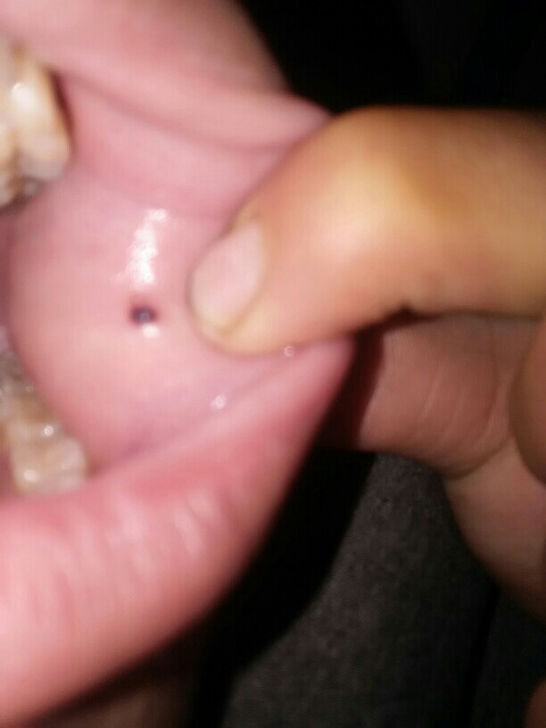 口腔内壁小米粒图图片