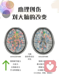 研究表明，童年創(chuàng)傷會改變大腦神經(jīng)網(wǎng)絡(luò)結(jié)構(gòu)，包括情緒調(diào)節(jié)、獎勵預(yù)期、以及威脅檢測回路。圖中顯示，童年不良經(jīng)歷對大腦左前扣帶活躍度有明顯的影響，此處神經(jīng)鏈接密度降低，導(dǎo)致情緒調(diào)節(jié)能力降低，注意力難以集中，自我驅(qū)動力降低，以及認(rèn)知功能降低。
      重要的是，我們的大腦具有可塑性，在積極的治療和調(diào)節(jié)，大腦可以得到重塑。配圖