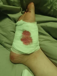 腳底板受傷筋斷了，，縫針了，如何走路如何上廁所，如何洗澡？配圖