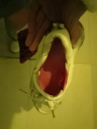 腳底板受傷筋斷了，，縫針了，如何走路如何上廁所，如何洗澡？配圖