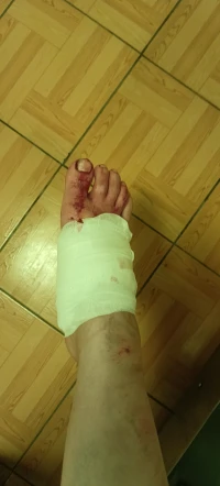 腳底板受傷筋斷了，，縫針了，如何走路如何上廁所，如何洗澡？配圖
