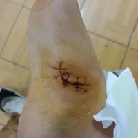 拆線了拆線了拆線了，今天鼓起勇氣看拆線的過程，邊看邊哭，但是還是不能走路。配圖