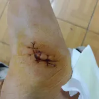 拆線了拆線了拆線了，今天鼓起勇氣看拆線的過程，邊看邊哭，但是還是不能走路。配圖
