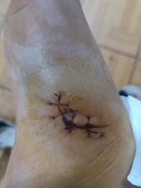 拆線了拆線了拆線了，今天鼓起勇氣看拆線的過程，邊看邊哭，但是還是不能走路。配圖