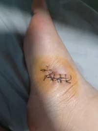 拆線了拆線了拆線了，今天鼓起勇氣看拆線的過程，邊看邊哭，但是還是不能走路。配圖