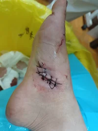 嗯好像好很多了.可以走路了，但是好像還是一瘸一拐，但是呢比單腳跳好多了配圖