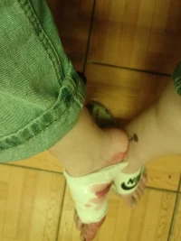 嗯好像好很多了.可以走路了，但是好像還是一瘸一拐，但是呢比單腳跳好多了配圖