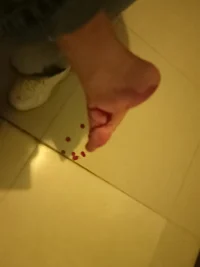 嗯好像好很多了.可以走路了，但是好像還是一瘸一拐，但是呢比單腳跳好多了配圖