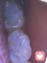 拔牙，美颜使人强大配图