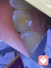 拔牙，美颜使人强大配图