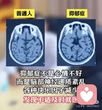 神经递质紊乱配图