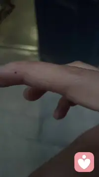 今天被小区流浪猫抓了，晚上打了6针！手都肿了配图