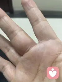 今天被小区流浪猫抓了，晚上打了6针！手都肿了配图