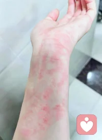 和过敏的第N次重逢，像一场宿命般的约定。
允许脆弱，允许不完美，允许这个偶尔会过敏的自己。